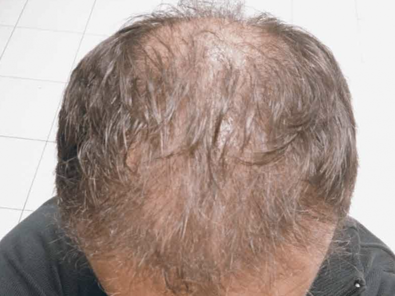 Greffe de cheveux ratée - homme cheveux clairsemé.