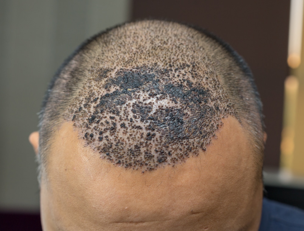 Greffe de cheveux ratée - Infections ou complications post-opératoires