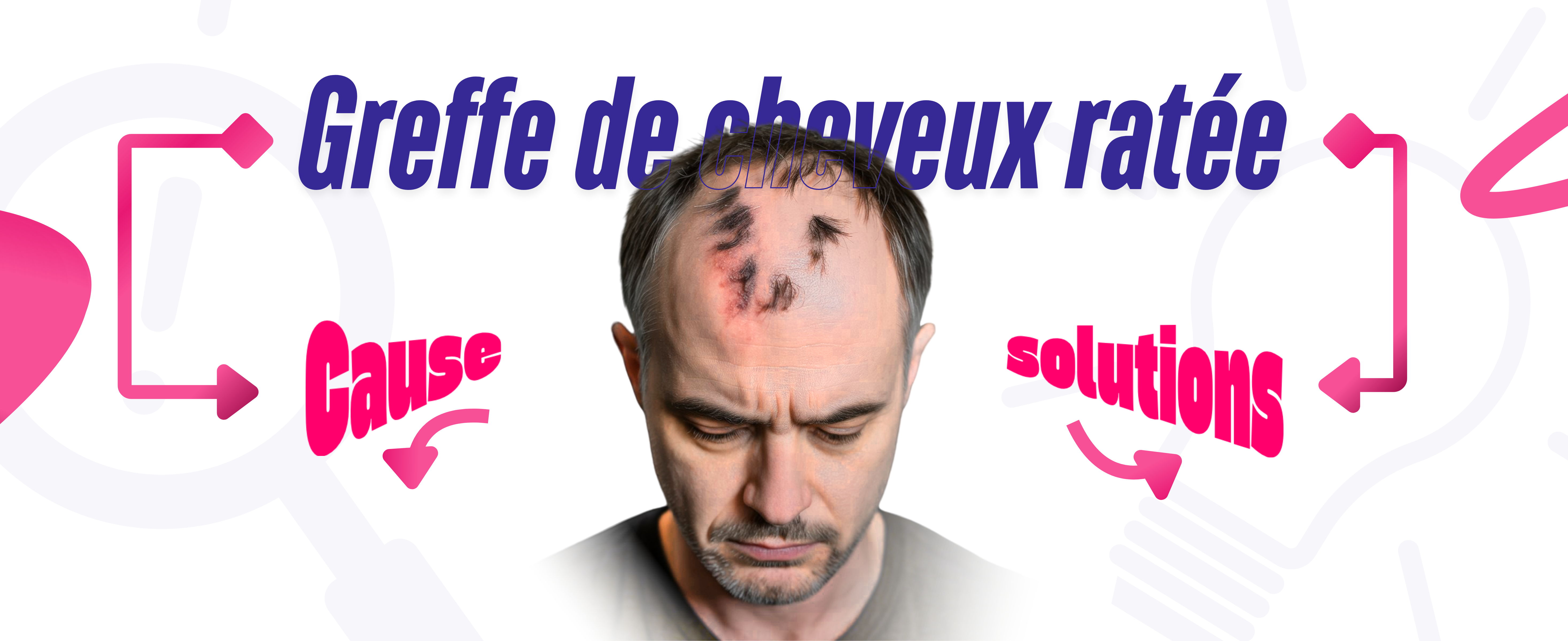 Greffe de cheveux ratée : Causes, solutions et conseils pour une correction réussie