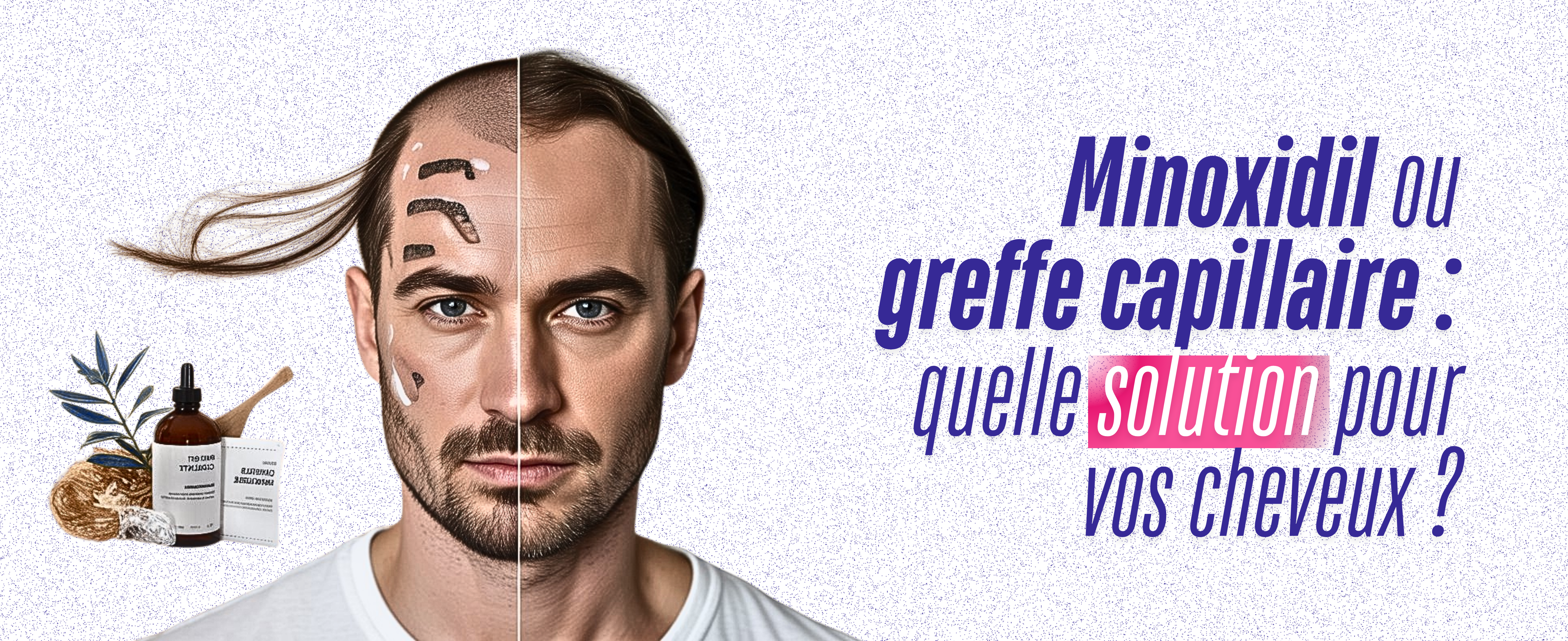 Alternatives au Minoxidil pour Cheveux: Greffe Efficace ?