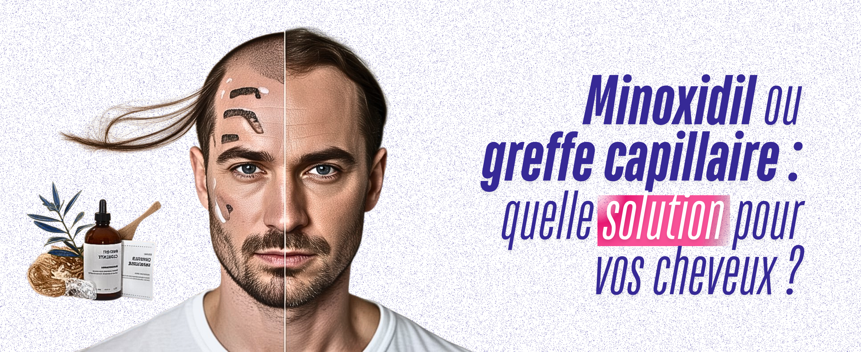 Alternatives au Minoxidil pour Cheveux: Greffe Efficace ?