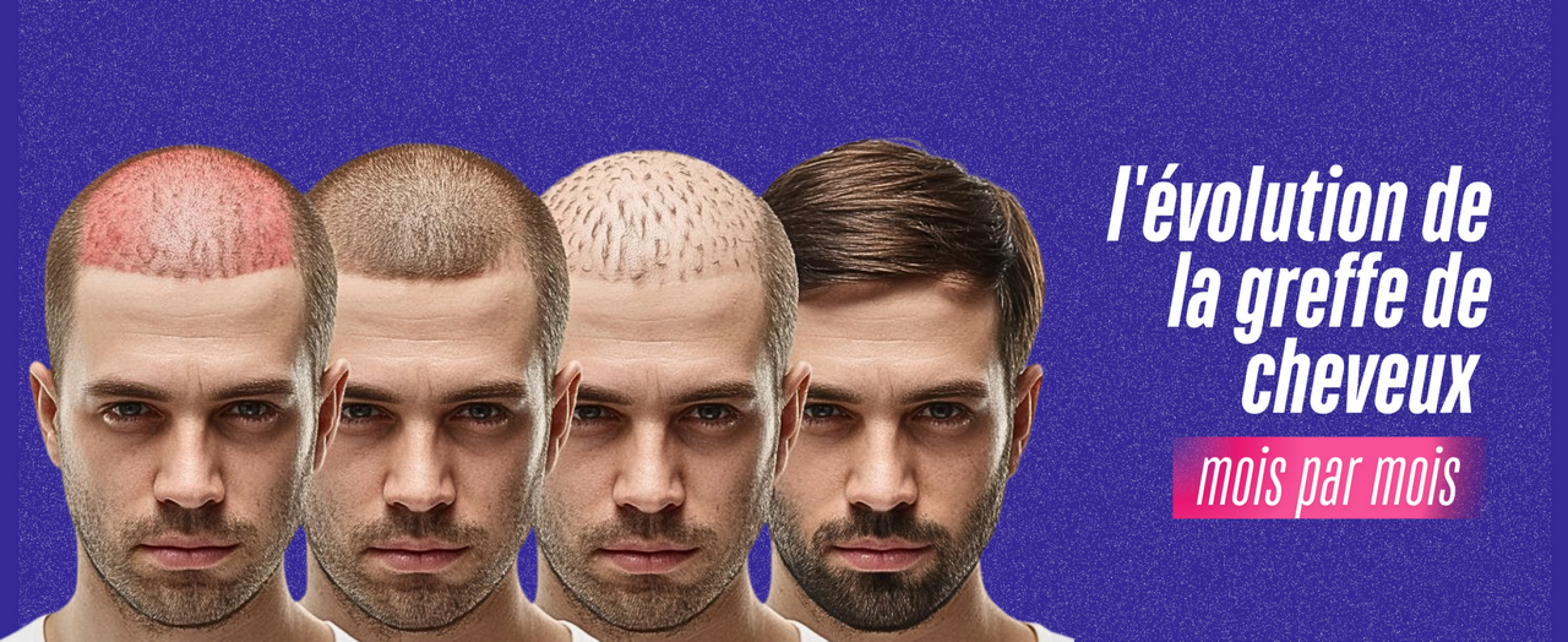 Greffe de cheveux : mois par mois