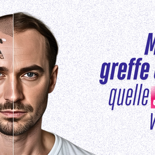 Alternatives au Minoxidil pour Cheveux: Greffe Efficace ?
