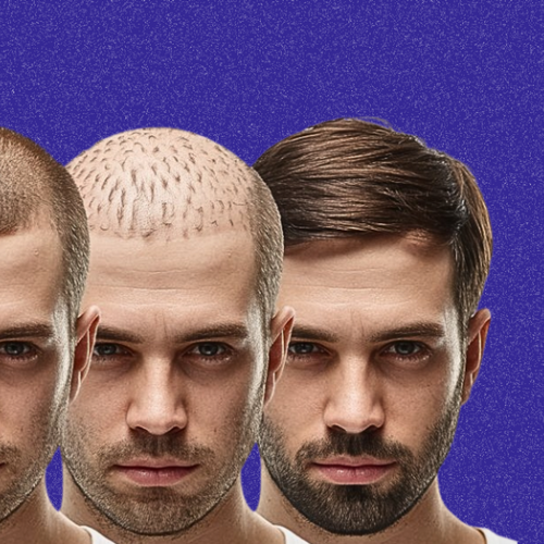 Greffe de cheveux : mois par mois